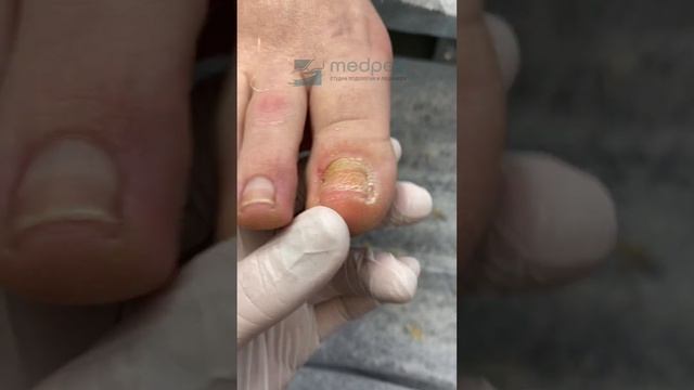 Сошел ноготь/Медпед/Травма ногтя/Что делать смотреть онлайн