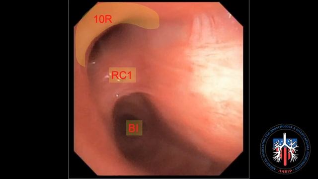 EBUS Lymph Node Station 10R смотреть онлайн