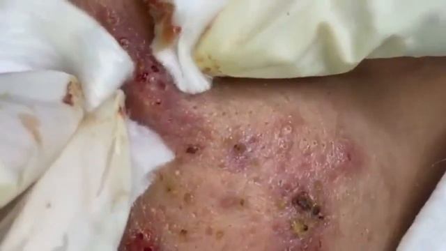 акне,черные точки, гнойники смотреть онлайн