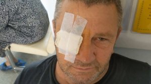 НАЗНАЧИЛИ  УКОЛЫ  В  ГЛАЗ.  НАЧАЛО ЛЕЧЕНИЯ.  ПЕРВЫЙ УКОЛ.