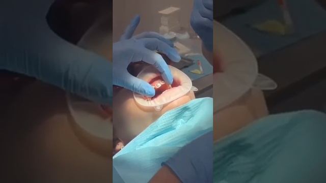 Техника 2х4-частичная брекет-система смотреть онлайн