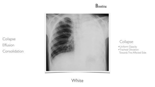 Chest X ray interpretation (in 10 minutes) for beginners??? #chestxray #cxr смотреть онлайн