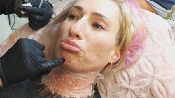 Mentalis muscle(фрагмент)