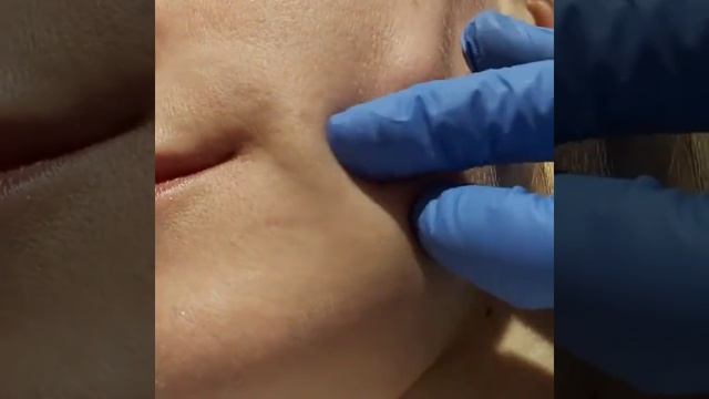 ?Слабонервным и особо впечатлительным не смотреть. Нитевой лифтинг