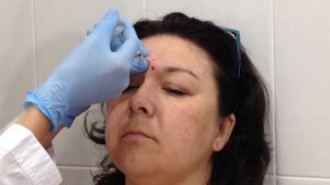 БОТОКС при морщинах МЕЖБРОВЬЯ! Практика ученицы, учимся колоть ПРАВИЛЬНО!