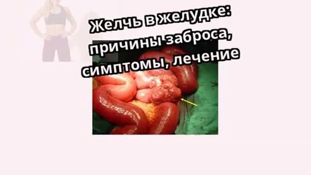 Желчь в желудке: причины заброса, симптомы, лечение смотреть онлайн