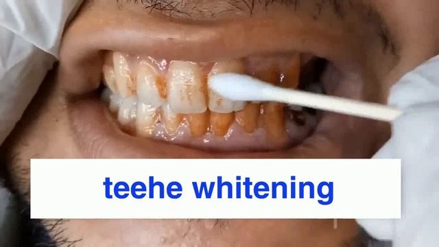 LANBENA TEETH WHITENING ESSENCE~1 смотреть онлайн