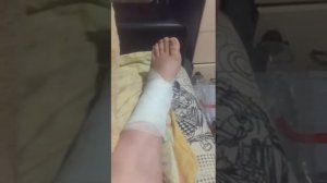 Двойной перелом голеностопа со смещением и подвывихом