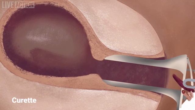 Процедура вакуумного аборта (вакуумная аспирация)