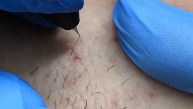 Процесс электроэпиляции, Набережные Челны смотреть онлайн