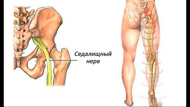 Хрен, картошка и мед от воспаления седалищного нерва. смотреть онлайн