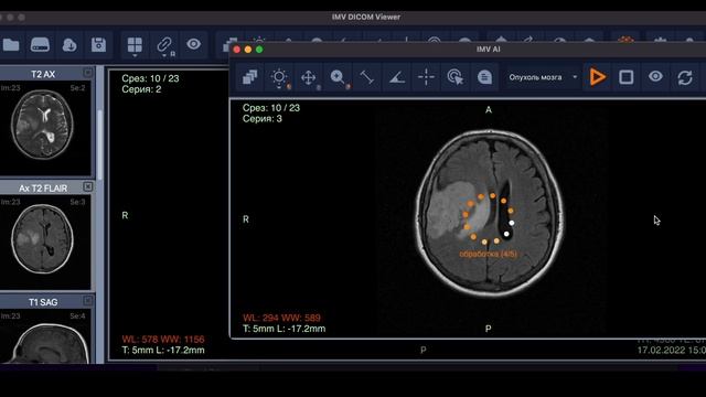 IMV DICOM Viewer: Introducing the AI-Powered IMV GLIOMAS Module for Brain Tumor Detection смотреть онлайн