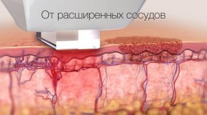 Фотоомоложение Люмекка