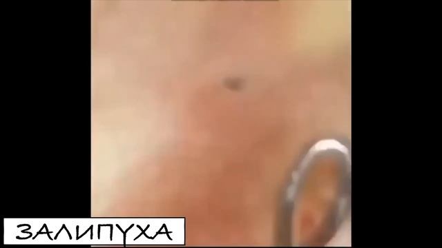 ПРЫЩИ \ ПРЫЩИ ВЫДАВЛИВАНИЕ \ ПОДБОРКА ВЫДАВЛИВАНИЕ ПРЫЩЕЙ #прыщи #acne #asmr #прыщиналице смотреть онлайн