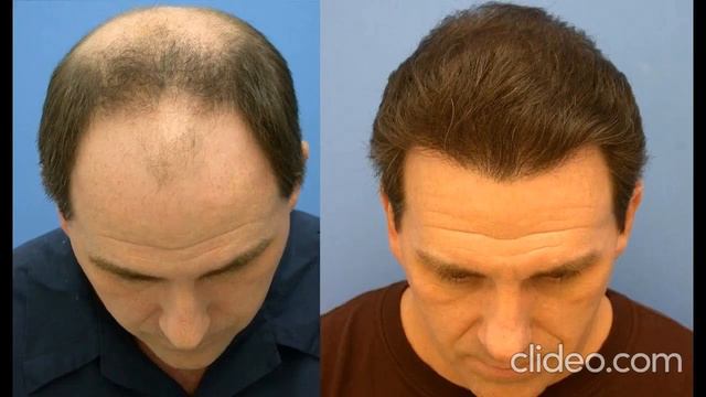 Minoxidil для густой шевелюры (man) смотреть онлайн