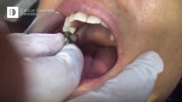 Osseointegration is essential for your dental implants! смотреть онлайн