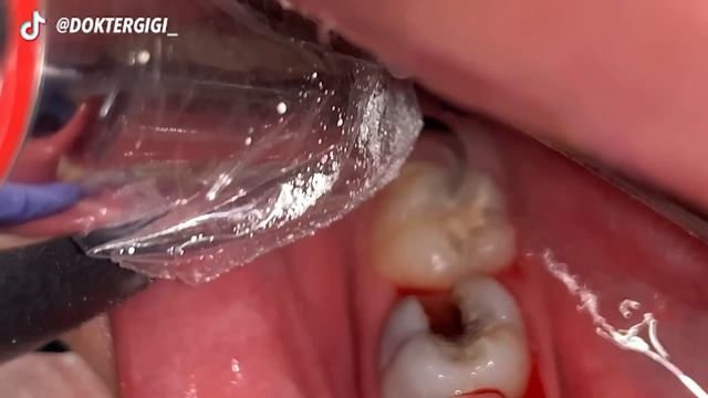 21 yo. Female's Teeth | Tartar Removal | Scaling | Dentist | Dokter Gigi Tri Putra смотреть онлайн