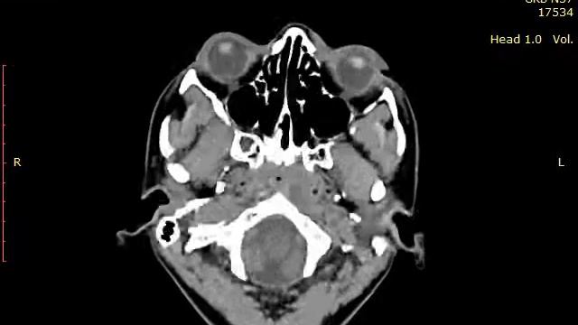 Хронический отёк верхнего века OS. КТ1 смотреть онлайн