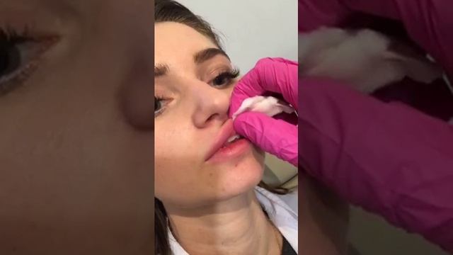 Doctor EDGAR Каминский Увеличение губ Juvederm Volift Retouch Lip Augmentation смотреть онлайн