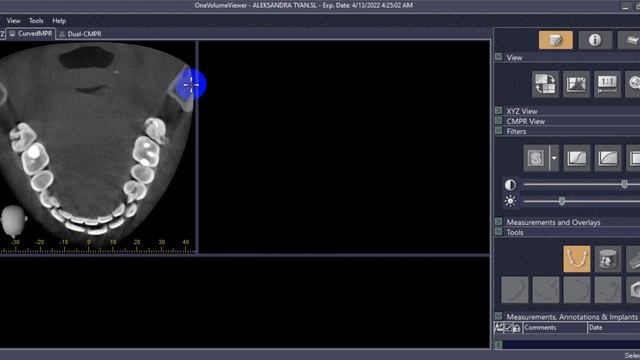 Работа с программой One Volume Viewer, часть 2 ( Ён Хи)