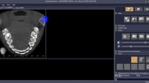 Работа с программой one volume viewer, часть 2 ( Ён Хи)
