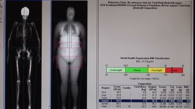 EPARC, UC San Diego - Dual-energy X-ray Absorptiometry смотреть онлайн