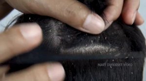 Удаление огромных чешуек перхоти #852