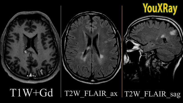 Характерные МР признаки рассеянного склероза