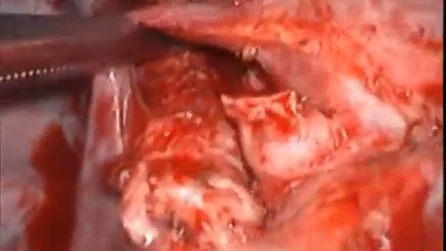 Routine Systematic Mediastinal Nodal Dissection During VATS... смотреть онлайн