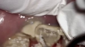 Удаление зубного камня, запущенный случай. Гигиена полости рта