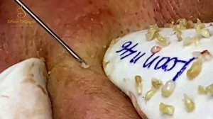 Professional bleckheads   Выдавливание черных точек прыщей   самое залипательное видео 2023