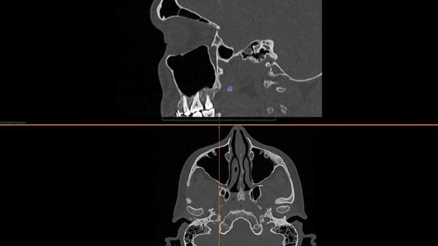 КРЫЛОНЕБНАЯ ЯМКА АНАТОМИЯ смотреть онлайн