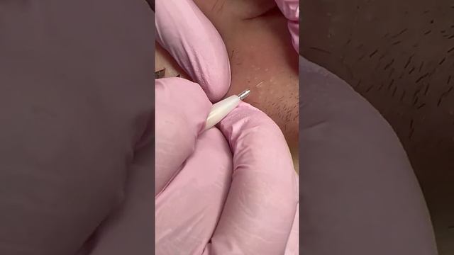 Как убрать волосы на лице. Запущенный случай смотреть онлайн