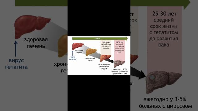 Цирроз фиброз печени смотреть онлайн