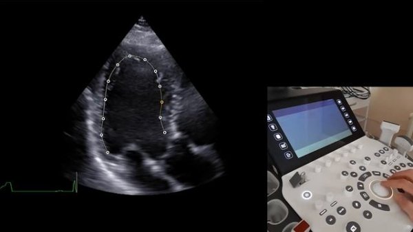 [2021.11.24_МК] Speckle tracking эхокардиография