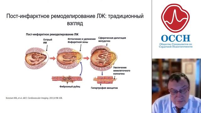 Целесообразность комбинации аспирина и пероральных антикоагулянтов у больных ХСН ишемической этиоло смотреть онлайн