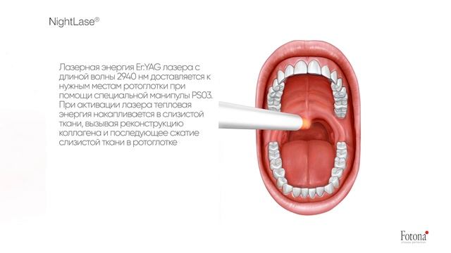 Эффективное лечение храпа и апноэ при помощи лазерной технологии Fotona смотреть онлайн