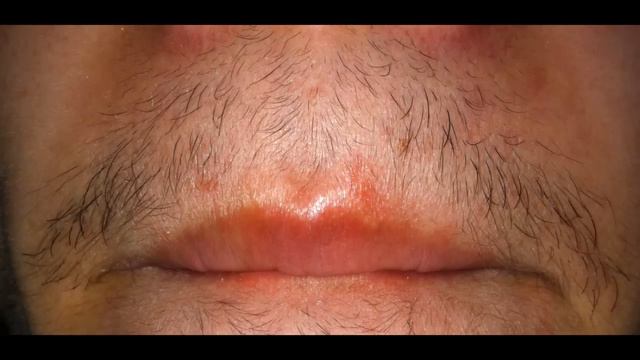 Minoxidil para la barba - Primer mes | Juan Daniel Osorio. смотреть онлайн