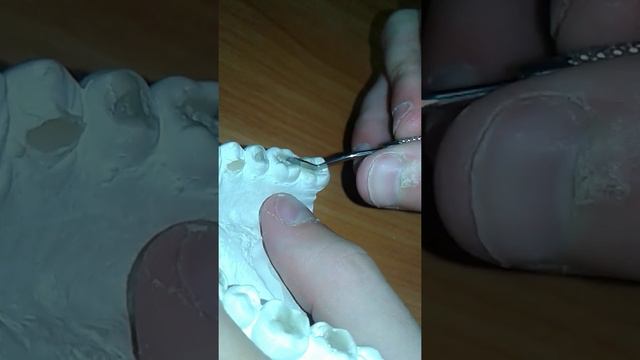 Пломбування зубів за блеком смотреть онлайн