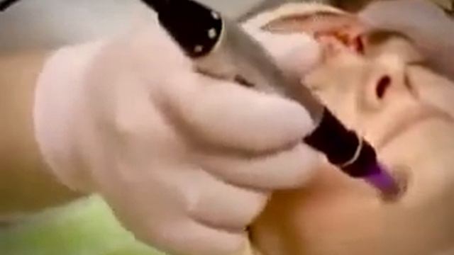 Фракционная мезотерапия смотреть онлайн