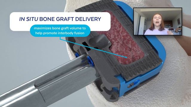 Globus Medical Magnify Stand Alone Spacer смотреть онлайн