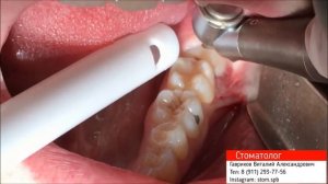 Удаление зуба мудрости ретинированного  Стоматолог Гавриков Виталий Александрович