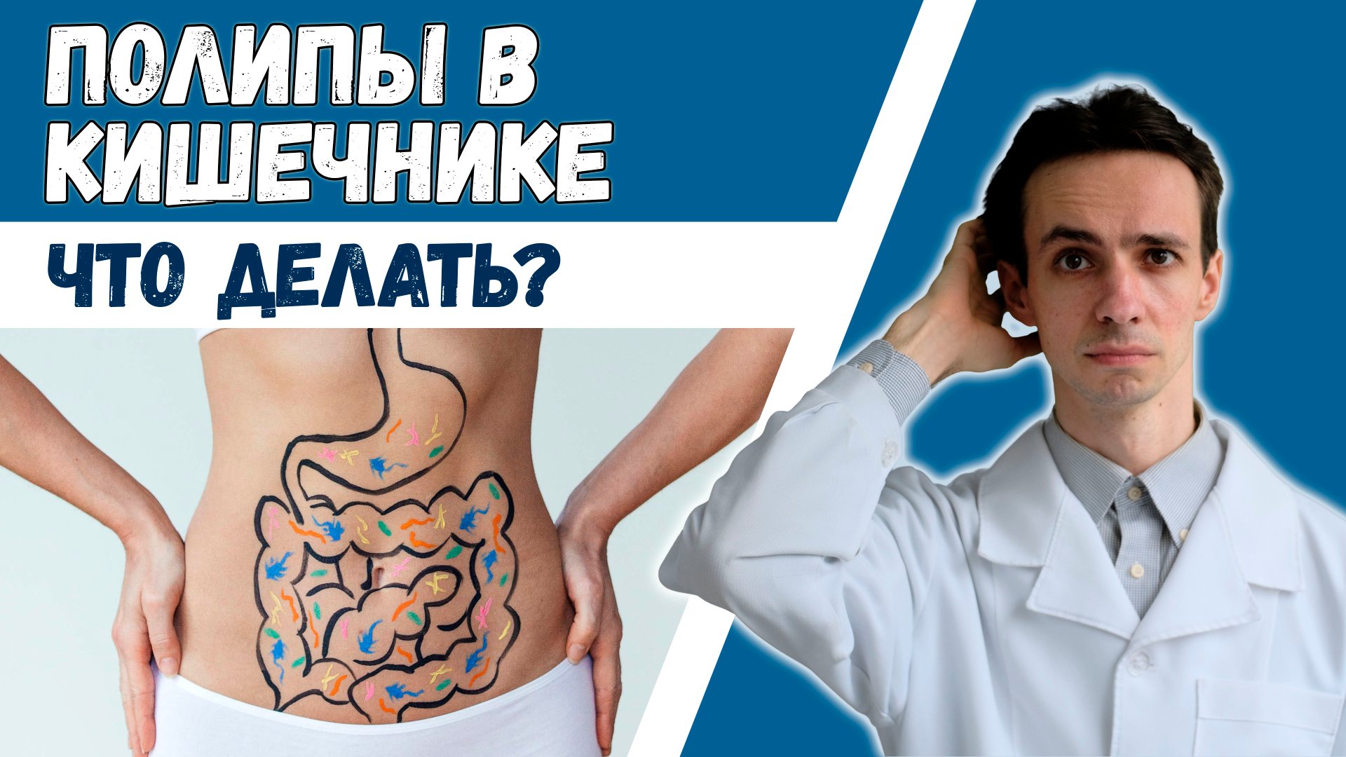 Полипы в кишечнике ? Опасны ли? Диагностика. Лечение. Профилактика