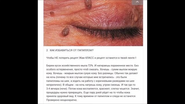 Как избавиться от папилломы ( совет ) смотреть онлайн