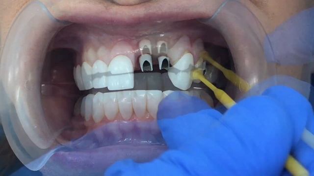 Unilaser | Diseño de Sonrisa sobre Implantes Dentales смотреть онлайн