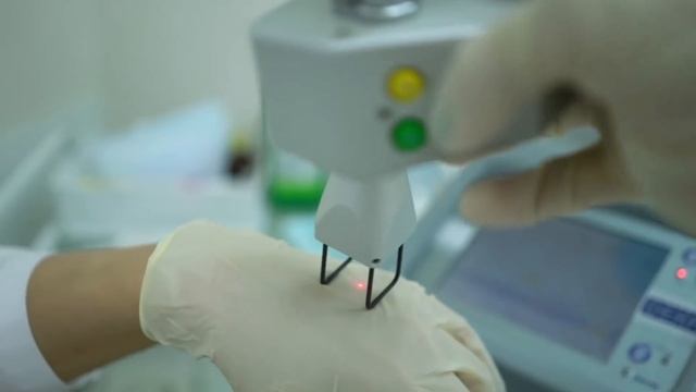 Лазерное удаление гиперпигментации | DEKA SYNCHRO QS4 смотреть онлайн