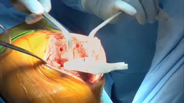 Outpatient Knee Surgery | Conformis