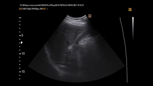 ЖКБ, подвижный камень (30-3-17)