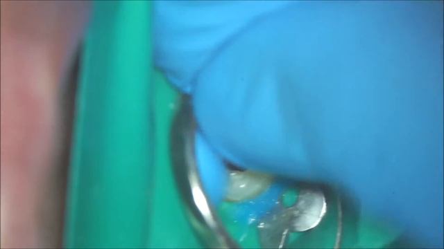 35 primary endo смотреть онлайн