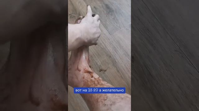 ПЕРЕЛОМ 2 ЛОДЫЖЕК С ПОДВЫВИХОМ ЧАСТЬ 1 смотреть онлайн